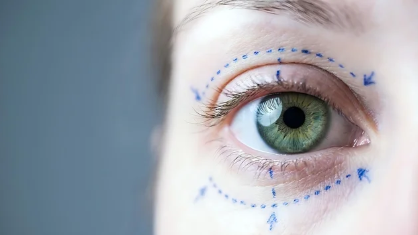 Asian Blepharoplasty