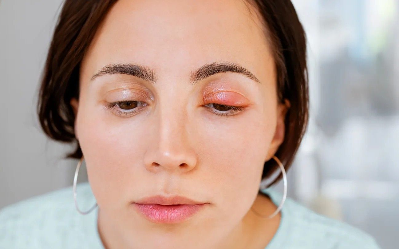 Exceptional Eyelid Surgery Background