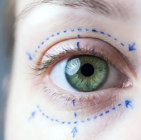 Lower Blepharoplasty