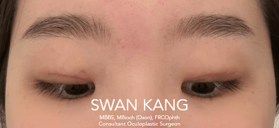 After double eyelid surgery, primary gaze