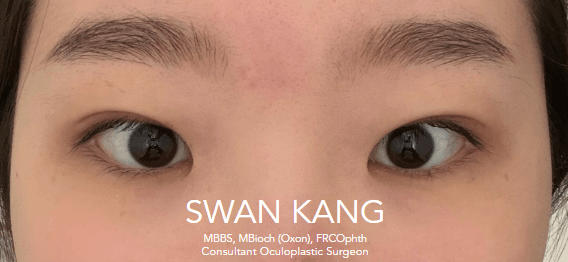 After double eyelid surgery, downgaze