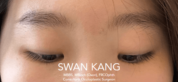 Before double eyelid surgery, primary gaze