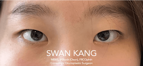 Before double eyelid surgery, downgaze